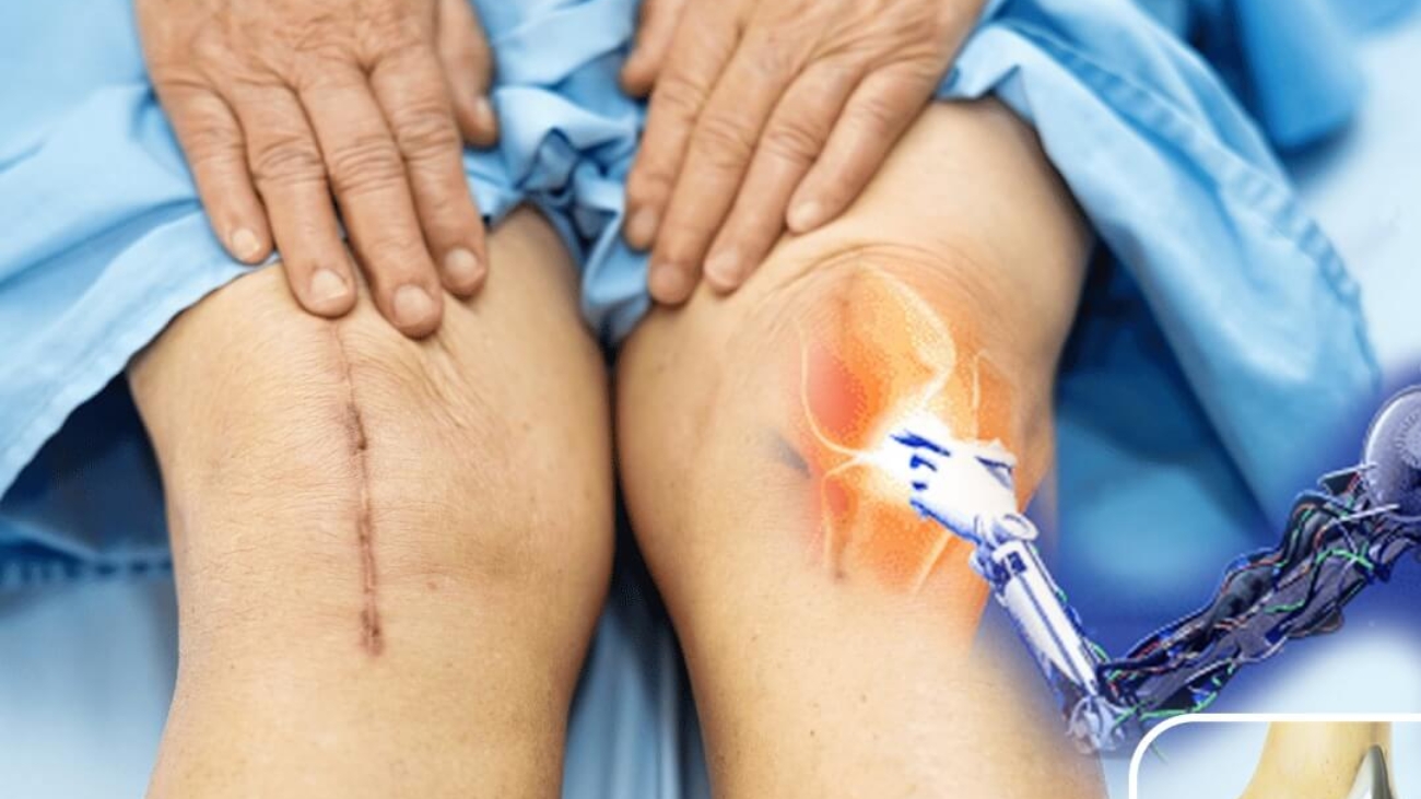 advangates of robotic knee replacemeny (1)